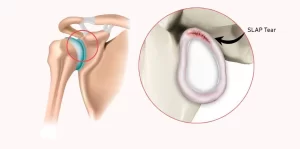 common shoulder injuries- SLAP Tear