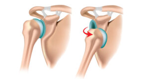 common shoulder injuries - shoulder pain