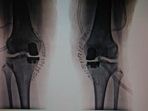 Parial Knee replacemement- X- ray of knee