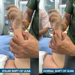 tfcc tear - Volar & Dorsal Shift of Ulna