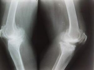 Knee pain- knee joint X-Ray