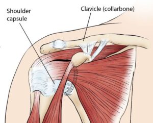 Common shoulder injuries - frozen shoulder