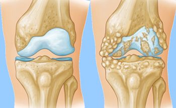 knee arthritis- knee surgery