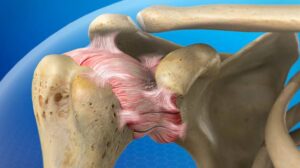 Frozen Shoulder- bone image