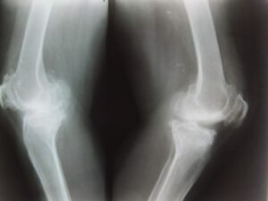 Knee arthritis- x-ray of knees