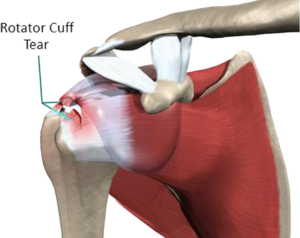 Shoulder Treatment - Rotator Cuff Tear 