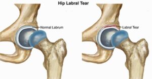 Hip Pain in Cold- Hip Labral Tear