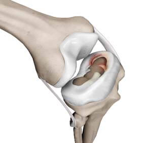 sports injuries- meniscal tear