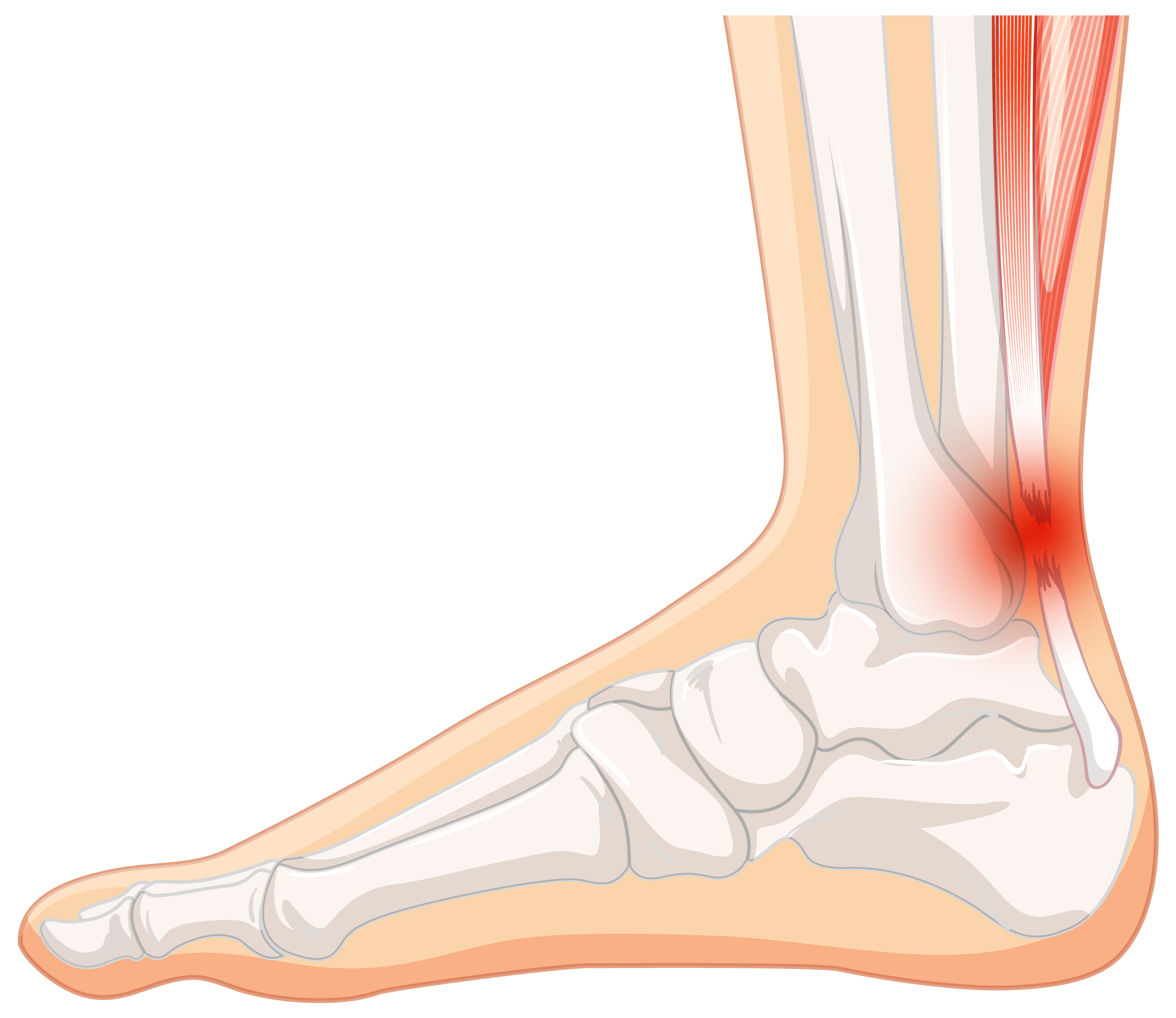 Achilles Tendon