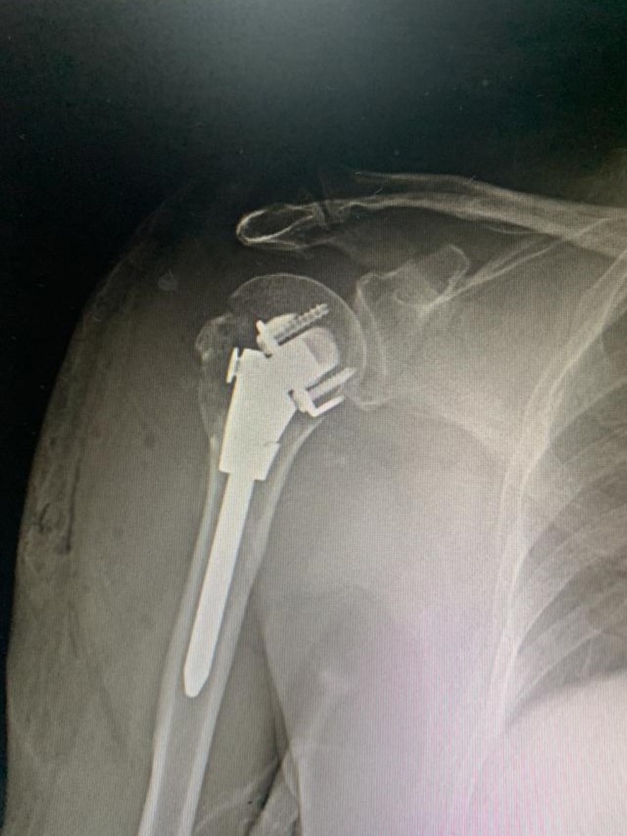 Say Goodbye To Shoulder Pain: The Expert Treatment options