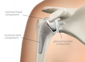 Shoulder Arthritis - TSR