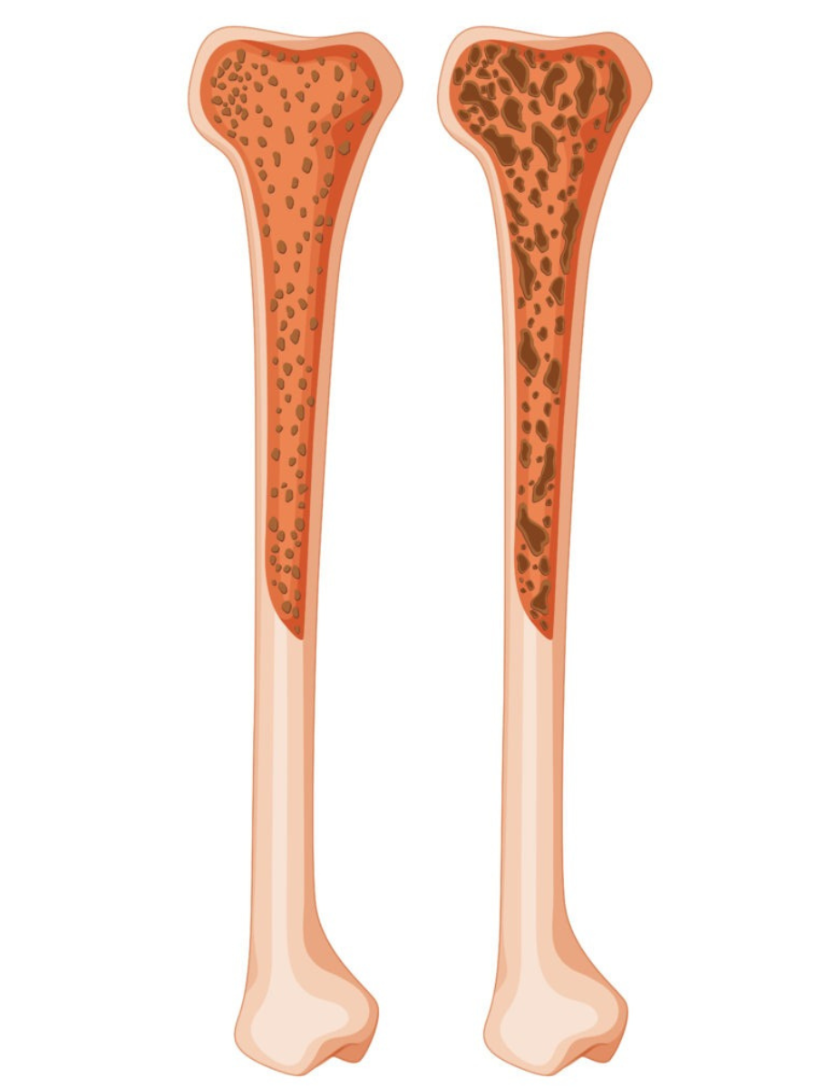 Prevent Osteoporosis: Know the Easy Steps To Boost Bone Health