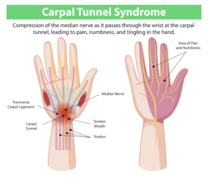 Carpel Tunnel Syndrome