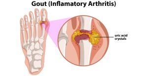 Types of Arthritis- Gout