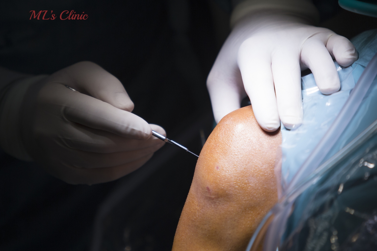 Know The Surprising Benefits Of Arthroscopy Joint Surgery