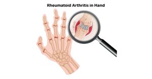 Types of Arthritis- Rheumatoid Arthritis