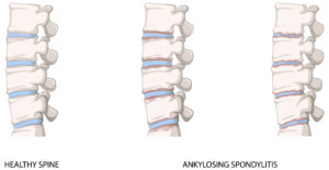 Types of Arthritis- Ankylosing spondylitis