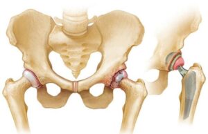 Joint Replacement Surgery - Hip