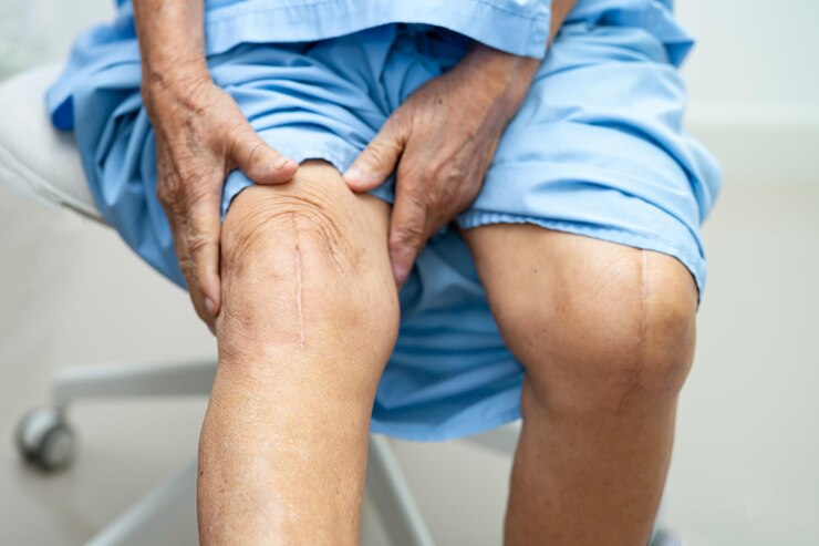 Knee Replacement Surgery - recovery