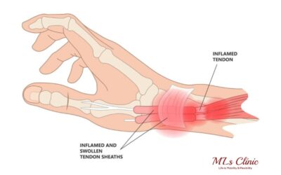 De Quervain’s Tenosynovitis | wrist pain | treatment of De Quervain's tenosynovitis | Finkelstein test for thumb pain