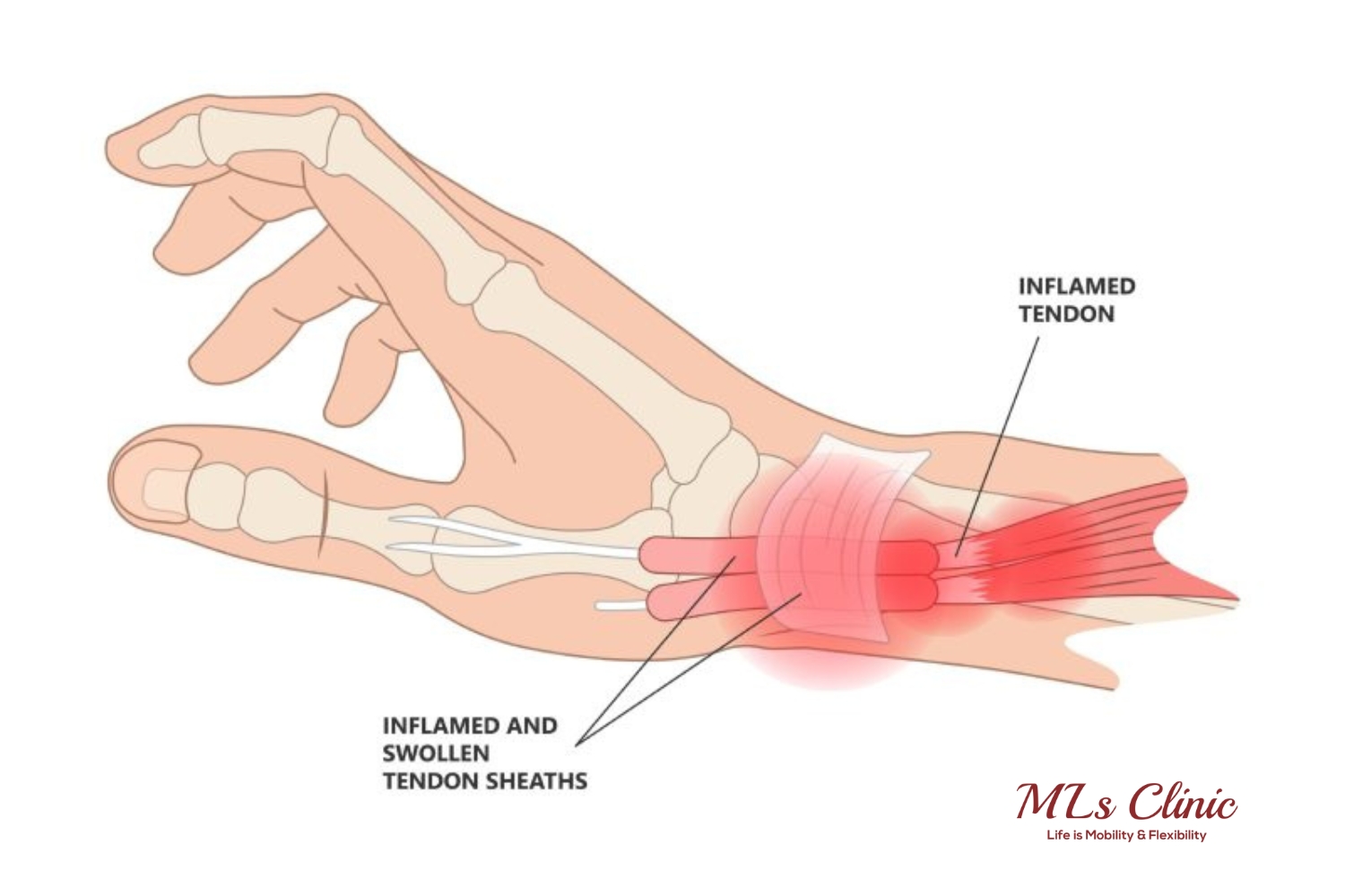 Know Wrist Pain: How To Recognize De Quervain’s Tenosynovitis?