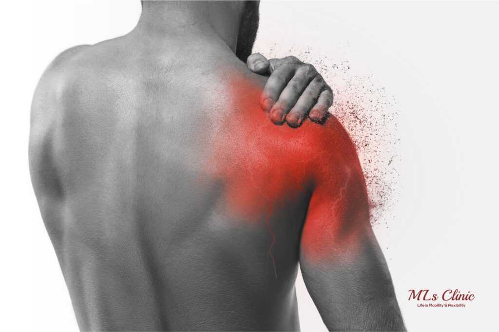 Myths about Frozen Shoulder