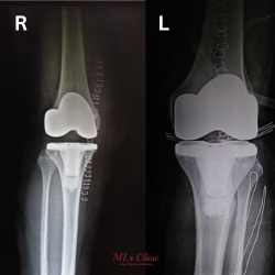 Bilateral Total Knee Replacement