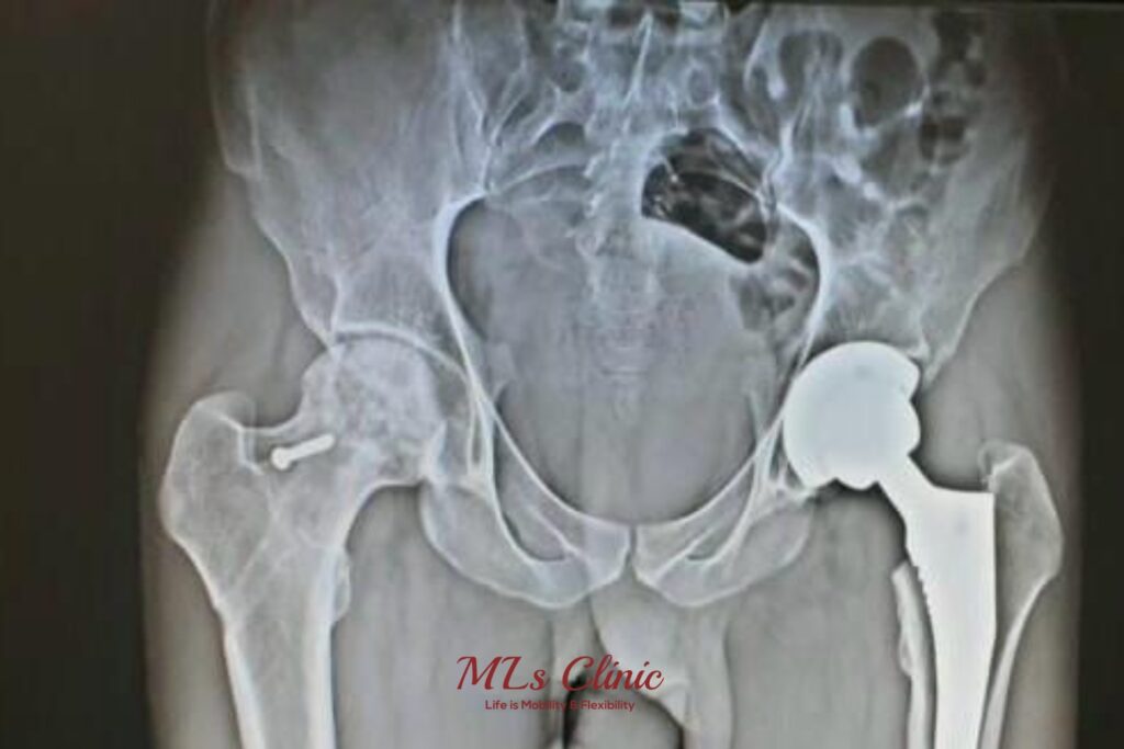 Pros and Cons of Hip Replacement