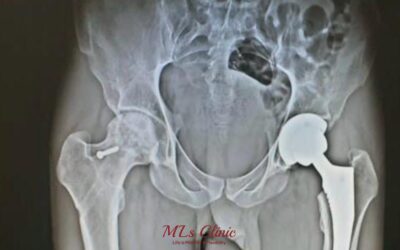 Pros and Cons of Hip Replacement