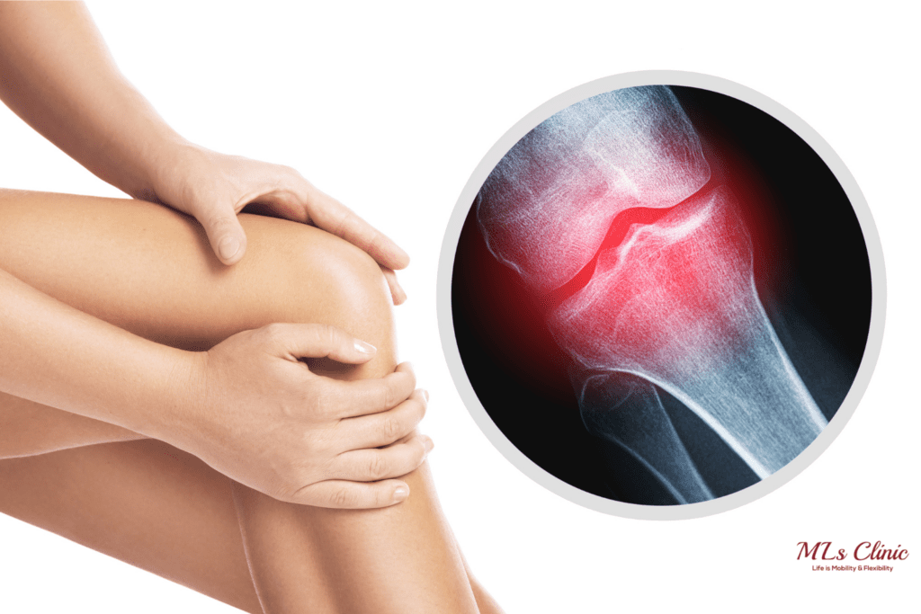 Top Causes of Osteoarthritis You Should Know!