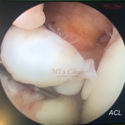 Meniscus Injuries