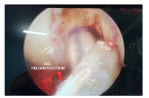 ACL Injury