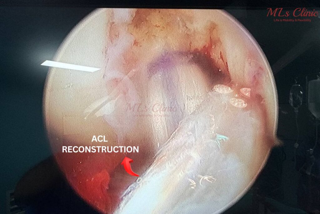 ACL Injury