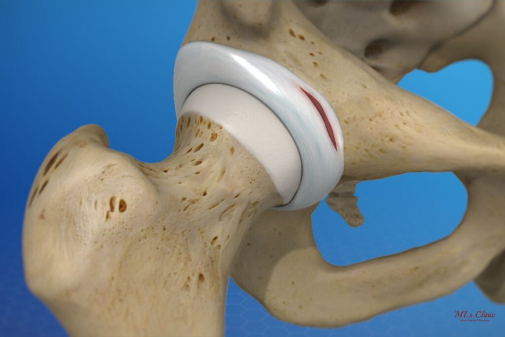 Signs and Symptoms of a Labrum Tear you shouldn’t ignore!