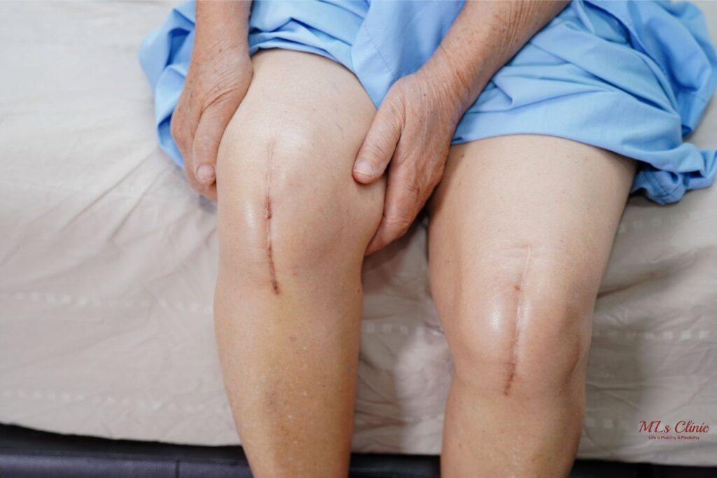 Top 10 Reasons to Stop Postponing Your Knee Replacement Surgery