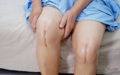 Knee Replacement Surgery- Disadvantages of delaying it