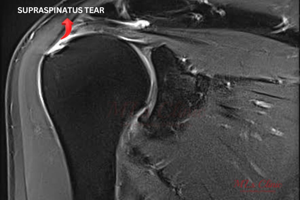 Rotator Cuff Injuries