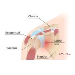 Labrum Tear- Shoulder Labrum Tear- MLs Clinic