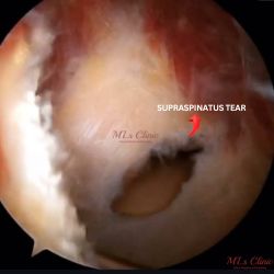 Rotator Cuff Injuries