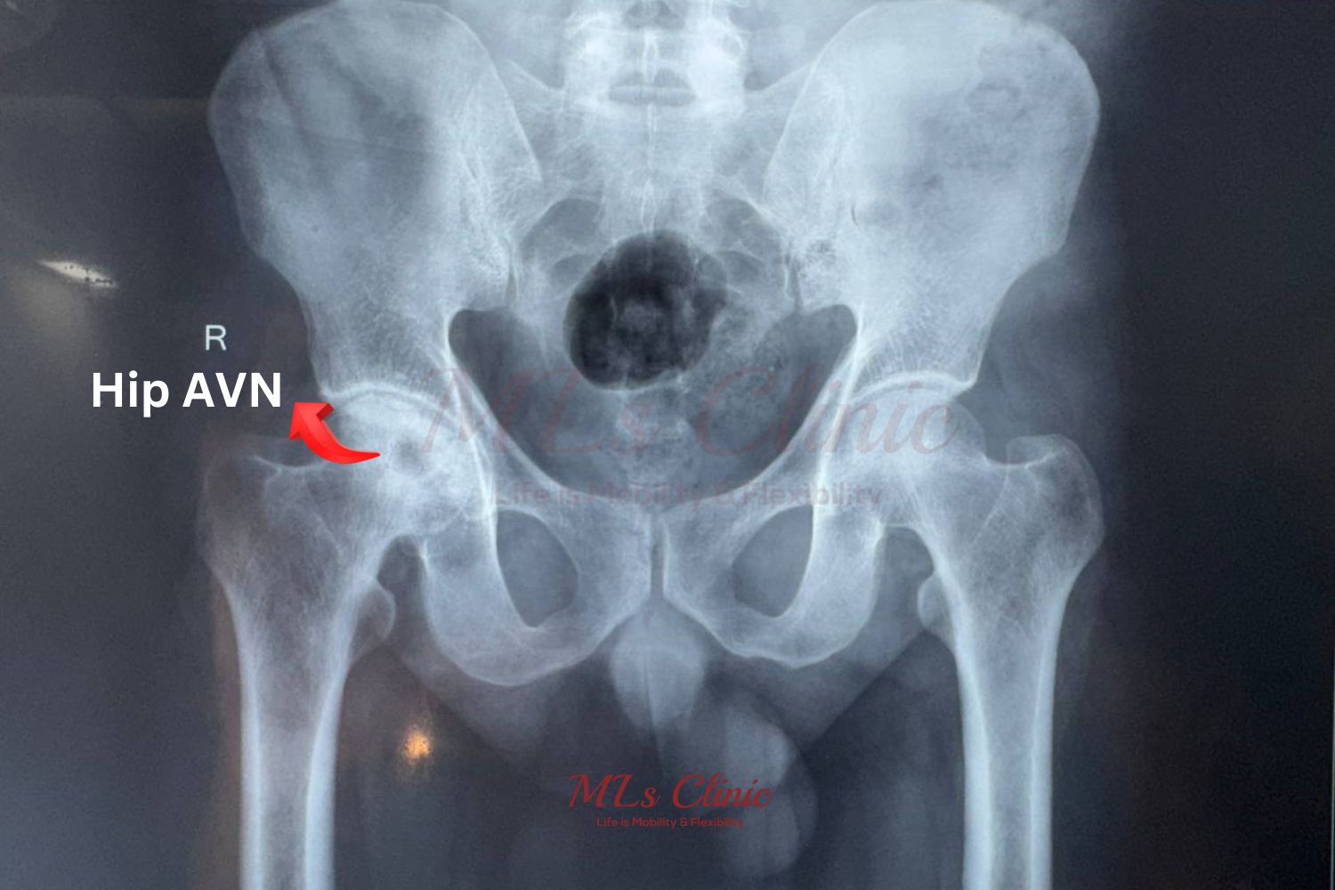 Hip Pain: Causes, Treatments, and Costs – Expert Insights from Dr. Preetesh Choudhary