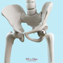 Robotic Hip replacement Surgery