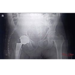 Hip Pain: Causes, Treatments, and Costs – Expert Insights from Dr. Preetesh Choudhary Hip pain