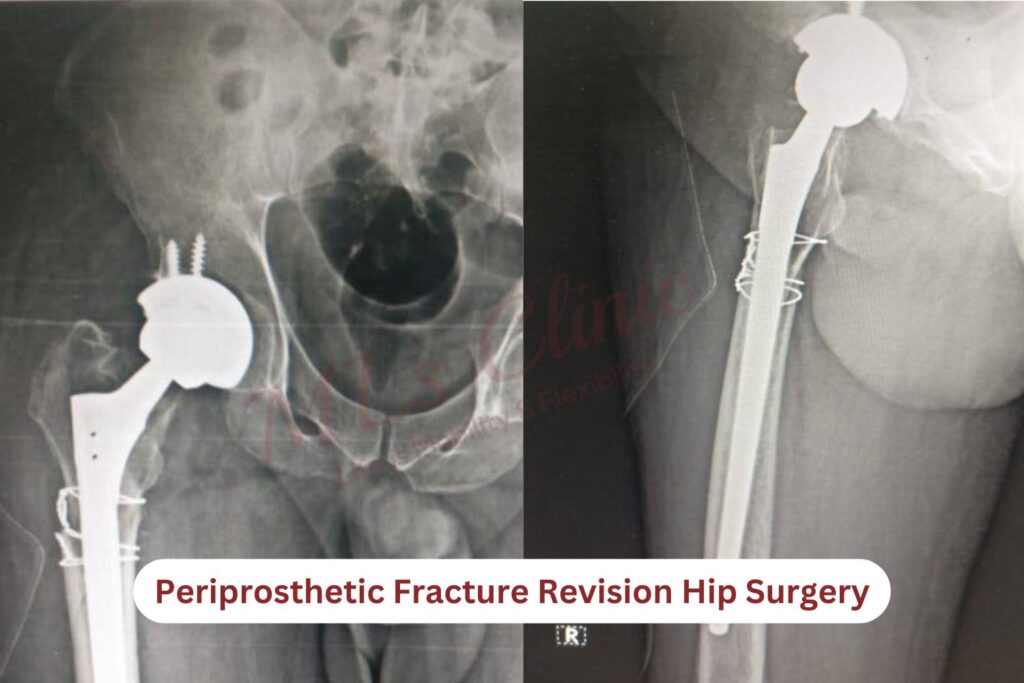 Revision Hip Replacement Surgery X-ray image by Dr. Preetesh Choudhary