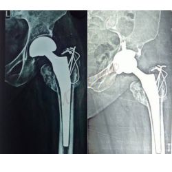 Revision Hip Replacement Surgery - Failed hemireplacement to total hip replacement - Loosening of the Implant