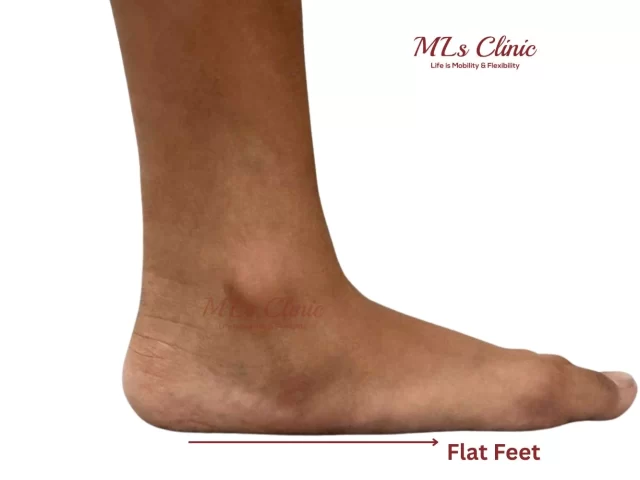 Flat Feet and Knee Pain: How to Fix the Root Cause Naturally?
