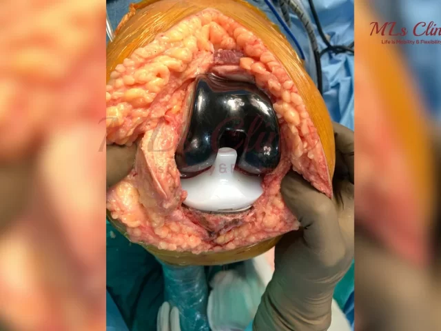 Need a Knee Replacement? Which types of Knee Implants are right for you?