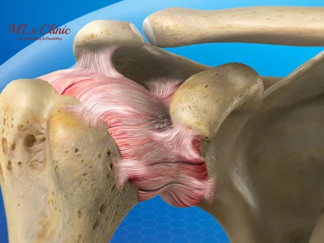 From Symptoms to Treatment for Frozen Shoulder: Relieving Shoulder Stiffness Effectively!