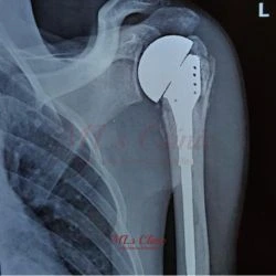 The ultimate guide to Do’s and Don’ts after Shoulder Replacement Surgery! Partial Shoulder Replacement Surgery- Hemiarthroplasty