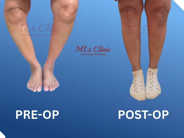 Robotic Knee Replacement Surgery: The Key To Faster Recovery!