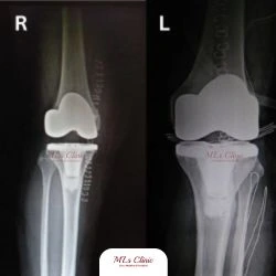 Robotic Knee Replacement Surgery: The Key To Faster Recovery! Robotic Knee Replacement Surgery The Key To Faster Recovery Orthopaedic Surgeon in Indore